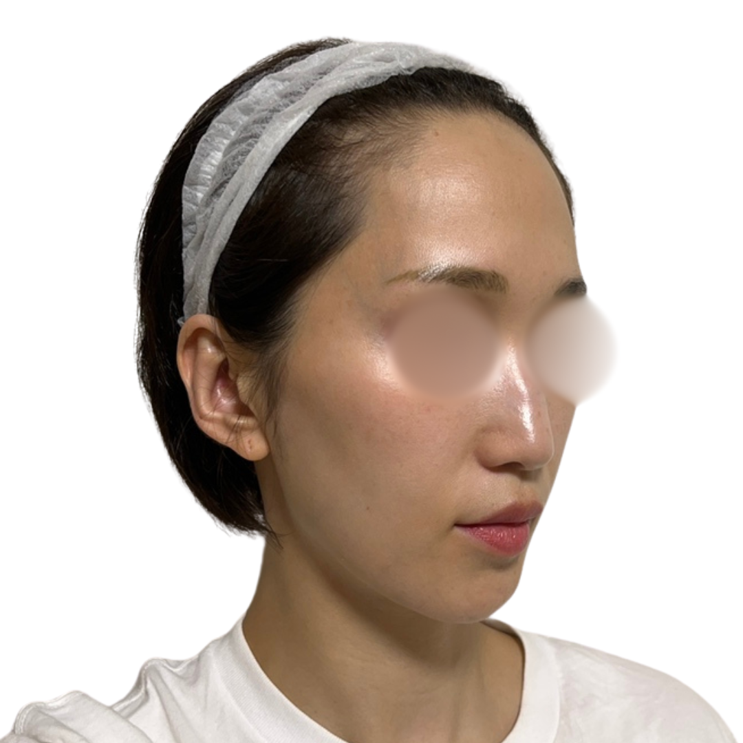 ピコフォーカス（ピコトーニング＋ピコフラクショナル）